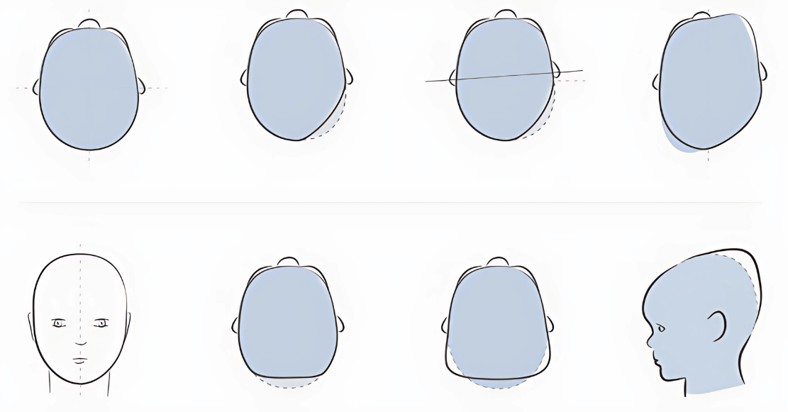 Positional Cranial Deformities (PCDs)